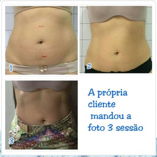  Criofrequência e Cavitação em Avaré por Clins - Clínica Integrada de Saúde