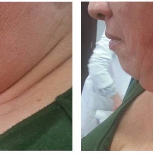 Criofrequência - Rosto em Avaré por Clins - Clínica Integrada de Saúde