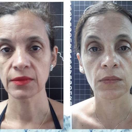 Criofrequência - Rosto em Avaré por Clins - Clínica Integrada de Saúde