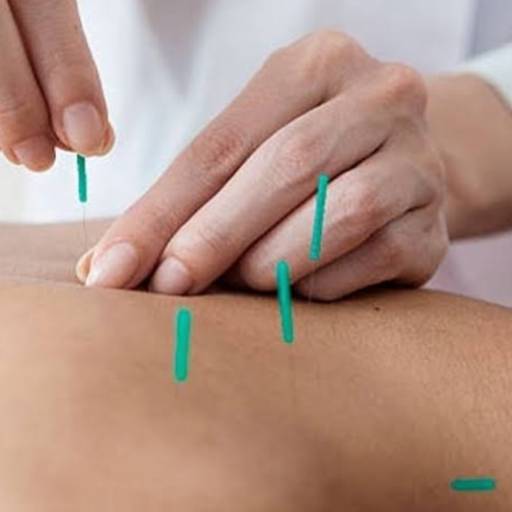 Dry Needling por Pollyanna Studio De Pilates e Fisioterapia
