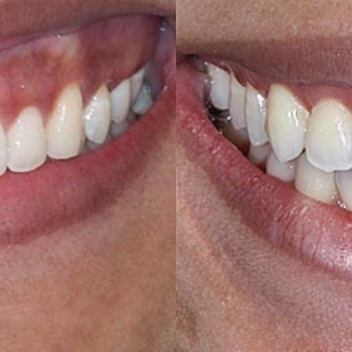 Gengivectoplastia por Dra. Nathália Quirino Bueno