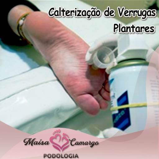 Cauterização de Verruga Plantar por Maísa Camargo Podologia