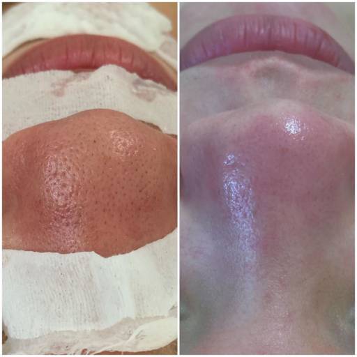 Limpeza de Pele por Tamara Meline Estetica