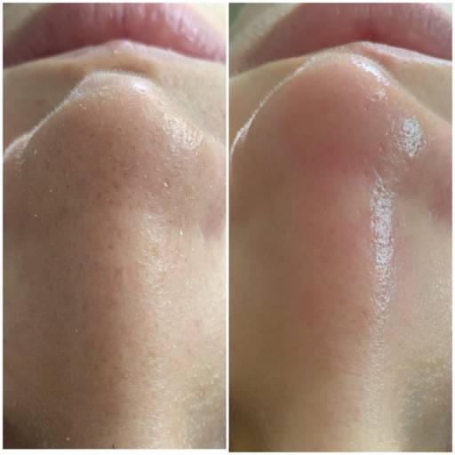 Limpeza de Pele por Tamara Meline Estetica