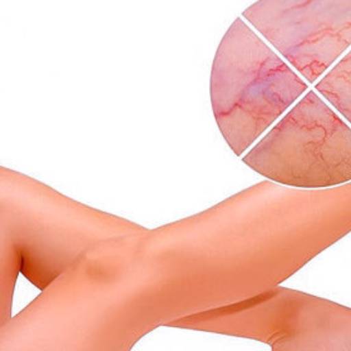 Escleroterapia por Medlabor - Medicina Laboratorial - Estância