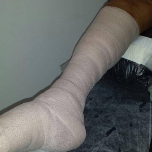 Tratamento de Úlcera Venosa por SuaVidaDe Cuidados Especiais com sua Pele