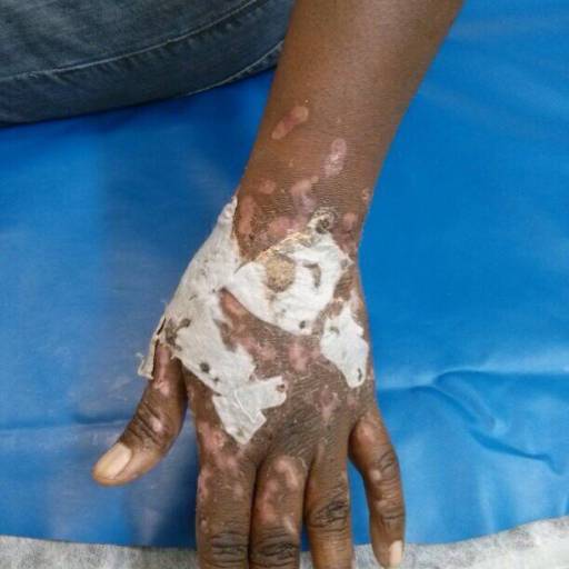 Tratamento de Queimaduras por SuaVidaDe Cuidados Especiais com sua Pele