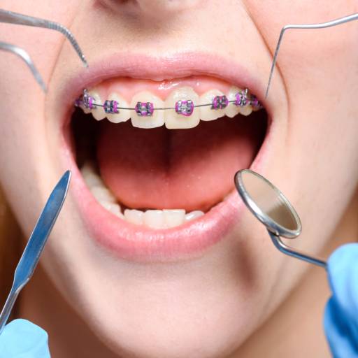 Comprar o produto de Ortodontia com aparelhos autoligáveis em Saúde Dental pela empresa Clínica de Ortodontia Dra. Eliana de Souza  em Araçatuba, SP por Solutudo