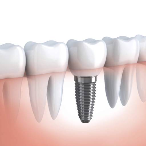 Implante Dentário por Clínica de Ortodontia Dra. Eliana de Souza 
