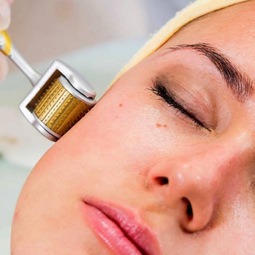 Microagulhamento - Pele Renovada e Revitalizada no Centro Estético Anita Lopes por Centro Estético Anita Lopes