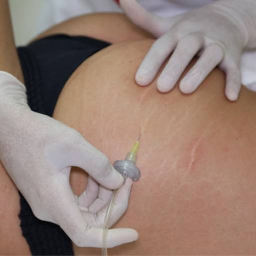 Tratamento para Estrias - Pele Suave e Uniforme no Centro Estético Anita Lopes por Centro Estético Anita Lopes