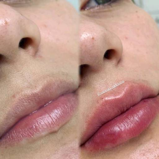 Preenchimento Labial por Sartori Odontologia CR0-SP 19464 - RT: Patrícia Sartori CR0 106940