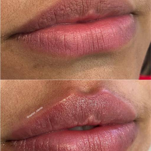 Preenchimento Labial por Sartori Odontologia CR0-SP 19464 - RT: Patrícia Sartori CR0 106940