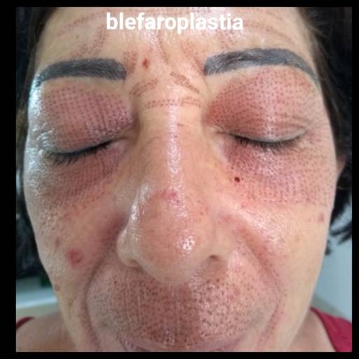 Comprar o produto de Blefaroplastia em Estética Facial pela empresa Rosana Fernandes - Especialista em Limpeza de Pele (Studio R) em Jaboticabal, SP por Solutudo