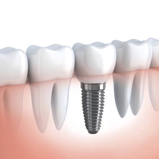 Implante Dentario por Peloso & Pelozo Odontologia Ltda