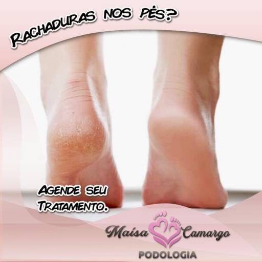 Tratamento para Rachaduras Plantares