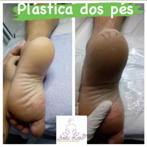 Plástica dos Pés - Cuide da Beleza e Saúde dos Seus Pés