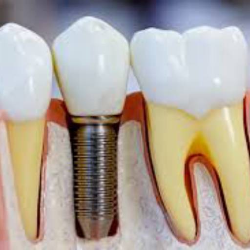 Ortodontia e Implante por Dra Vanessa Delfino e Equipe