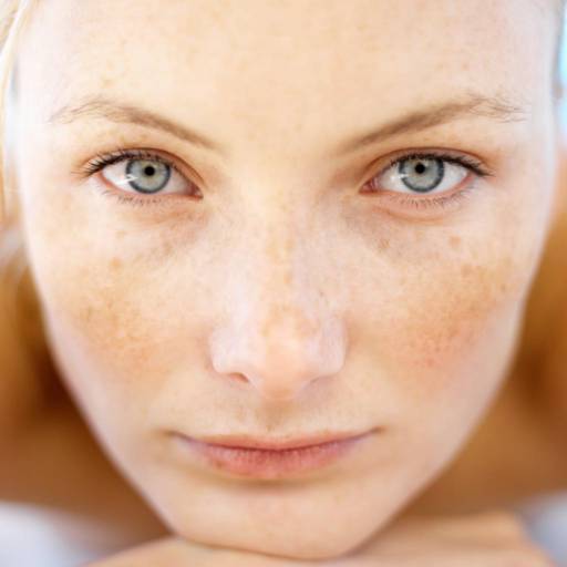 Tratamento para Melasma 