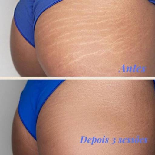 Tratamento para estrias