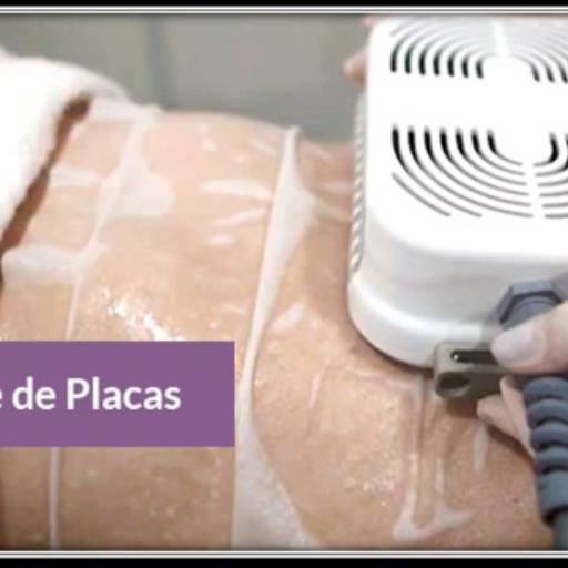 Criolipólise de placas