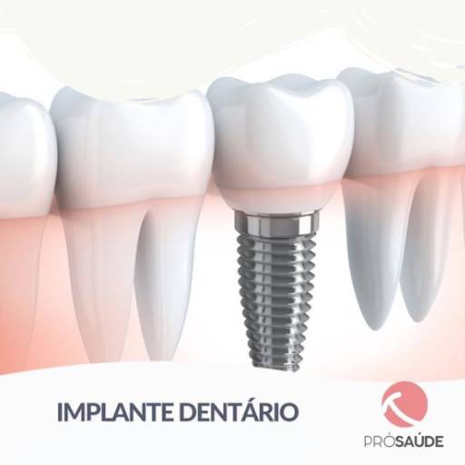 Implante dentário