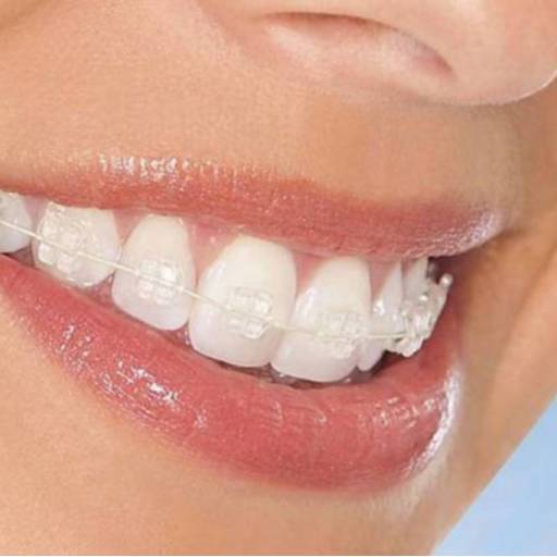 Comprar o produto de Aparelho Fixo em Tratamento Dentário pela empresa Clínica Sorriso - Nossa Senhora do Socorro em Aracaju, SE por Solutudo
