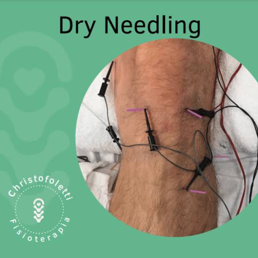 Dry Needling
