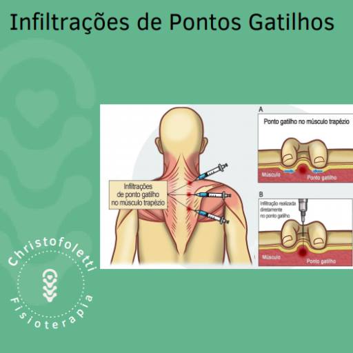 Dry Needling por Clínica Christofoletti Fisioterapia Estética Pilates