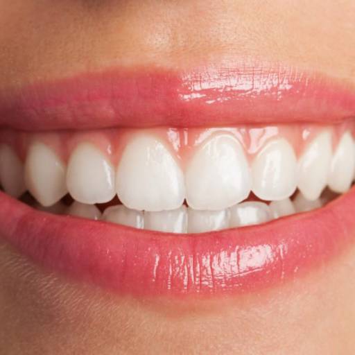 Comprar o produto de Lentes de contato dentais em Estética Odontológica pela empresa Miarelli - Consultório Odontológico Especializado em Jundiaí, SP por Solutudo