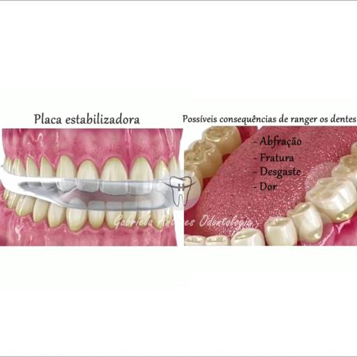 Comprar o produto de Tratamento de Bruxismo - Dra. Gabriela Antunes Silva  em Odontologia pela empresa Dra Gabriela Antunes Silva CRO-SP 88092 em Botucatu, SP por Solutudo