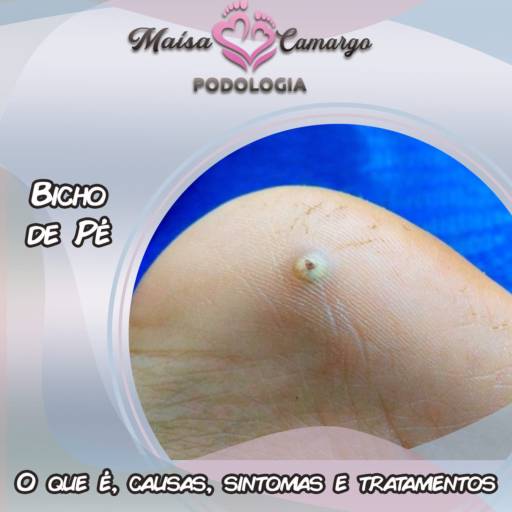 Tratamento para Bicho de Pé