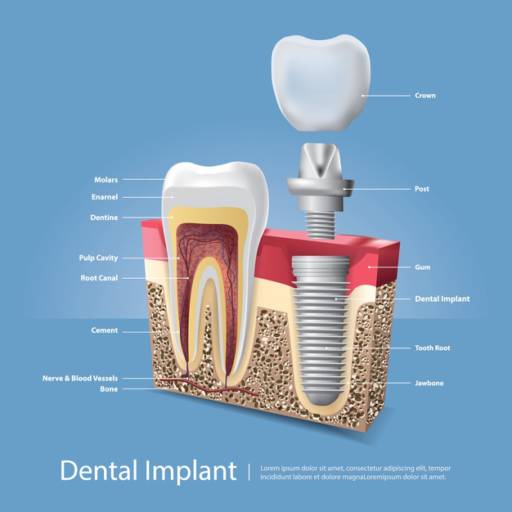 Implantes por OdontoCentro Botucatu CROCL 16047 - Dra Ana Zingra CROSP 99496
