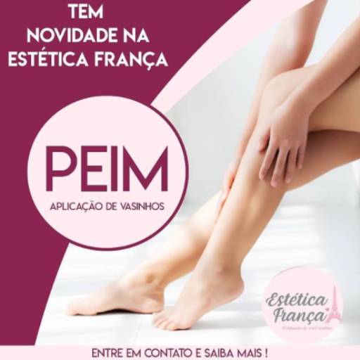 Tratamento de Vasinhos por Estética França