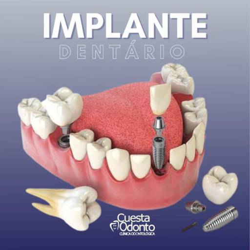 Comprar o produto de Implante Dentário em Odontologia pela empresa Cuesta Odonto em São Manuel, SP por Solutudo