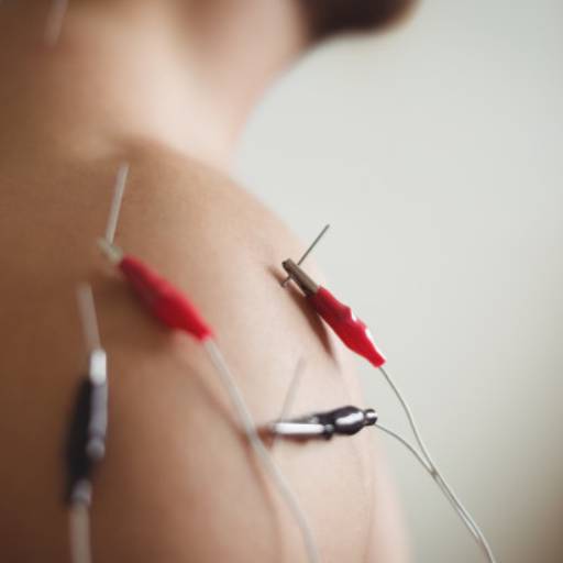 Eletroacupuntura
