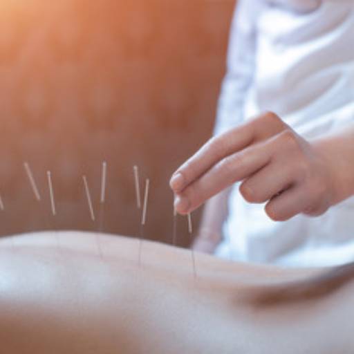 Acupuntura