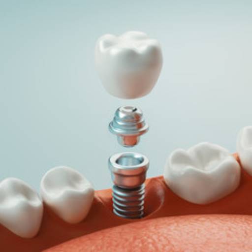Implantes Dentários por Marcela Borghi Odontologia