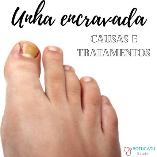 Uma das queixas mais comuns no consultório são as unhas encravadas. por Botucatu Saúde 