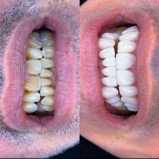 Facetas Em Resinas  por Clínica Odontológica Cimó
