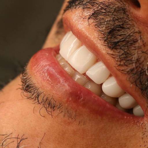 Facetas Em Resinas  por Clínica Odontológica Cimó