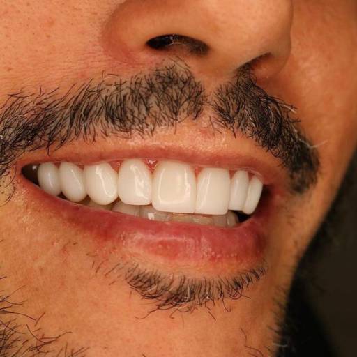 Facetas Em Resinas  por Clínica Odontológica Cimó