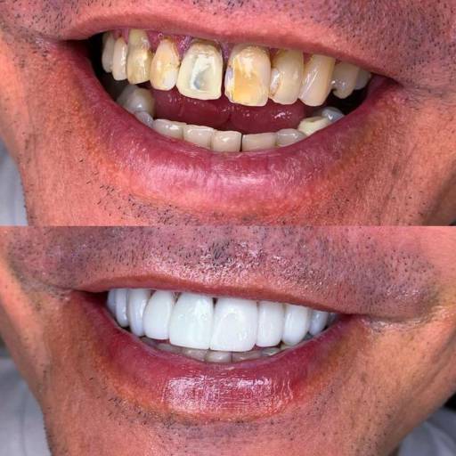 Facetas Em Resinas  por Clínica Odontológica Cimó