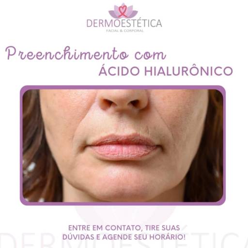 Preenchimento com Ácido Hialurônico  por Dermoestética Facial e Corporal