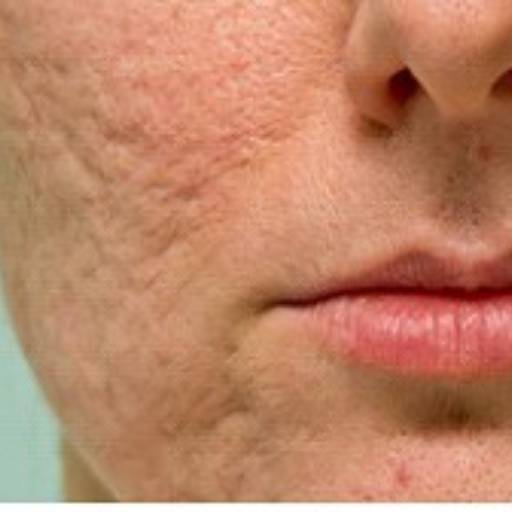 JATO DE PLASMA PURO por Centro Estético Anita Lopes