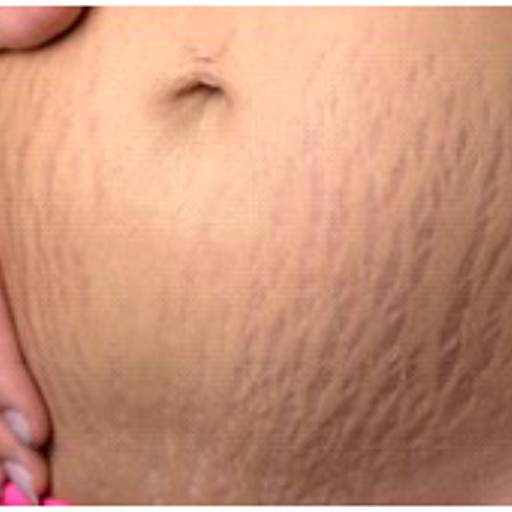 JATO DE PLASMA PURO por Centro Estético Anita Lopes