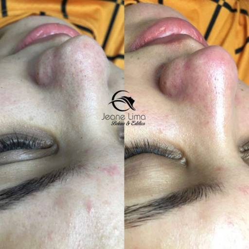Estética Facial  por Beleza e Estética Jeane Lima - Esteticista