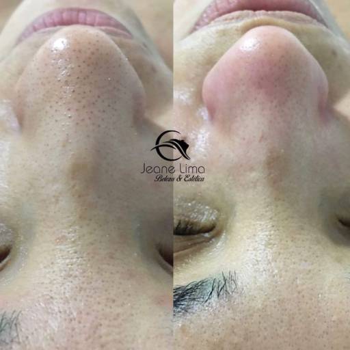 Estética Facial  por Beleza e Estética Jeane Lima - Esteticista