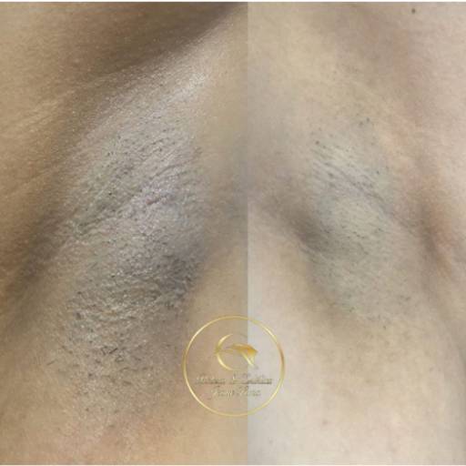 Depilação à Laser por Beleza e Estética Jeane Lima - Esteticista