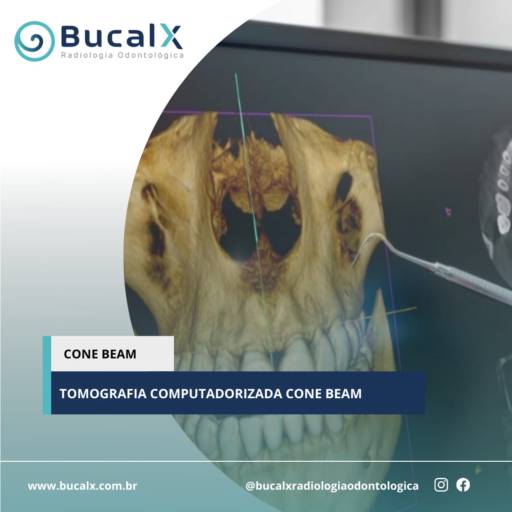 Cone Bean - Tomografia Computadorizada  por Bucalx Radiologia Odontológica